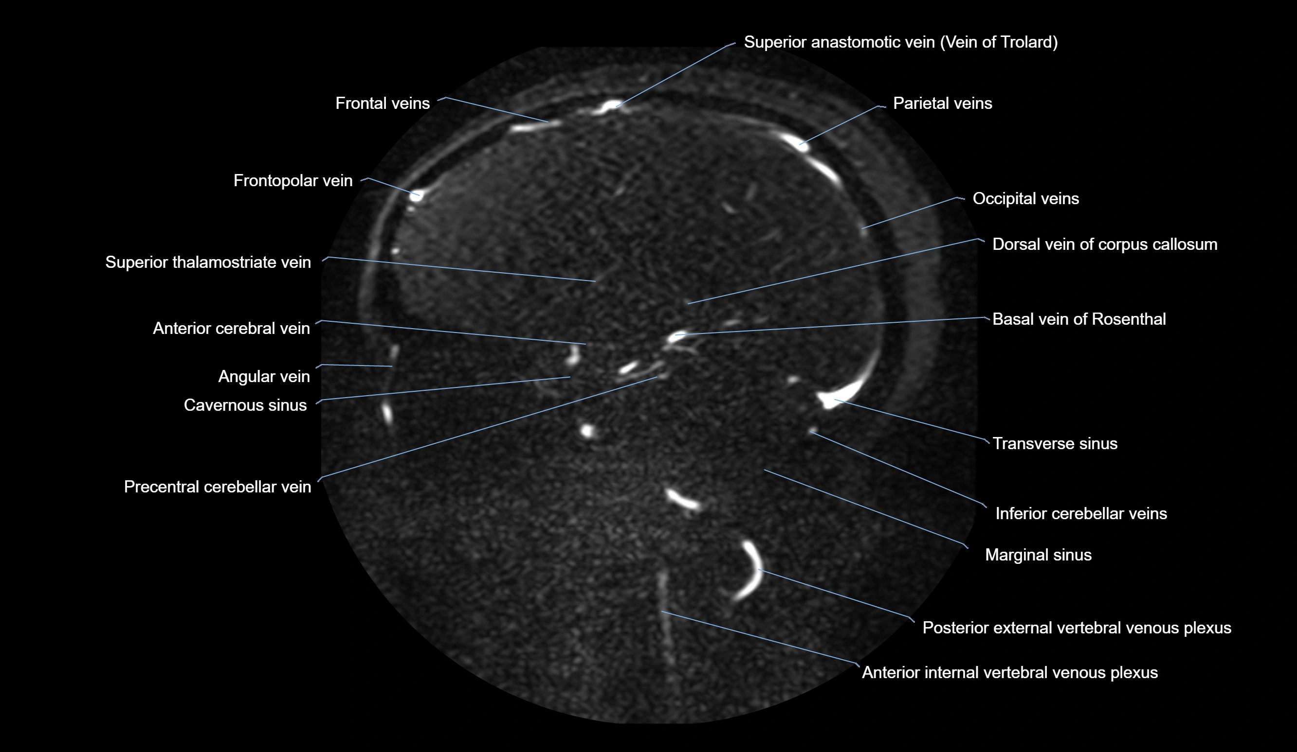 MRV brain sagittal anatomy 3T MRI labelledimages -00049.webp